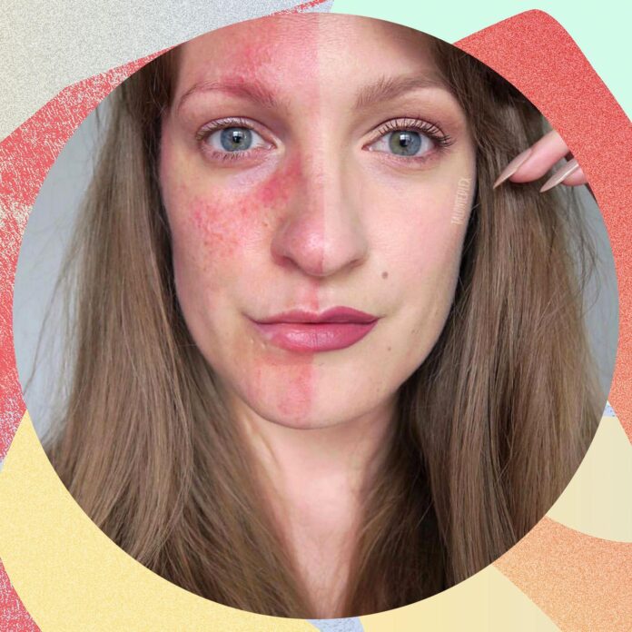 TheraFace Pro for Rosacea: Redness Reduction and Calming Effects